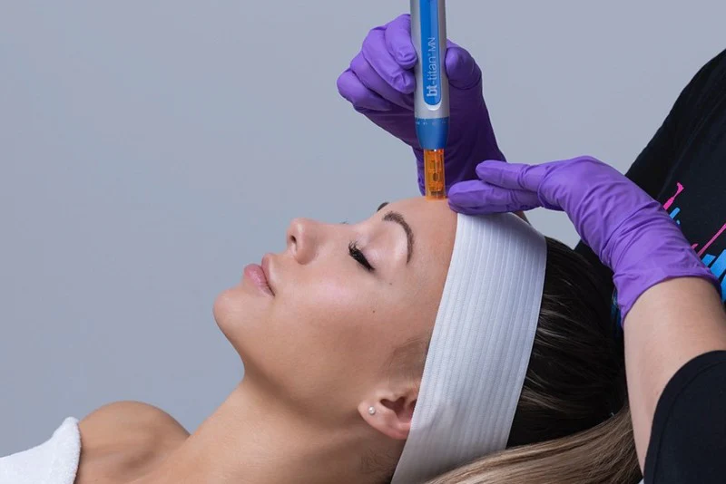 microneedling near me